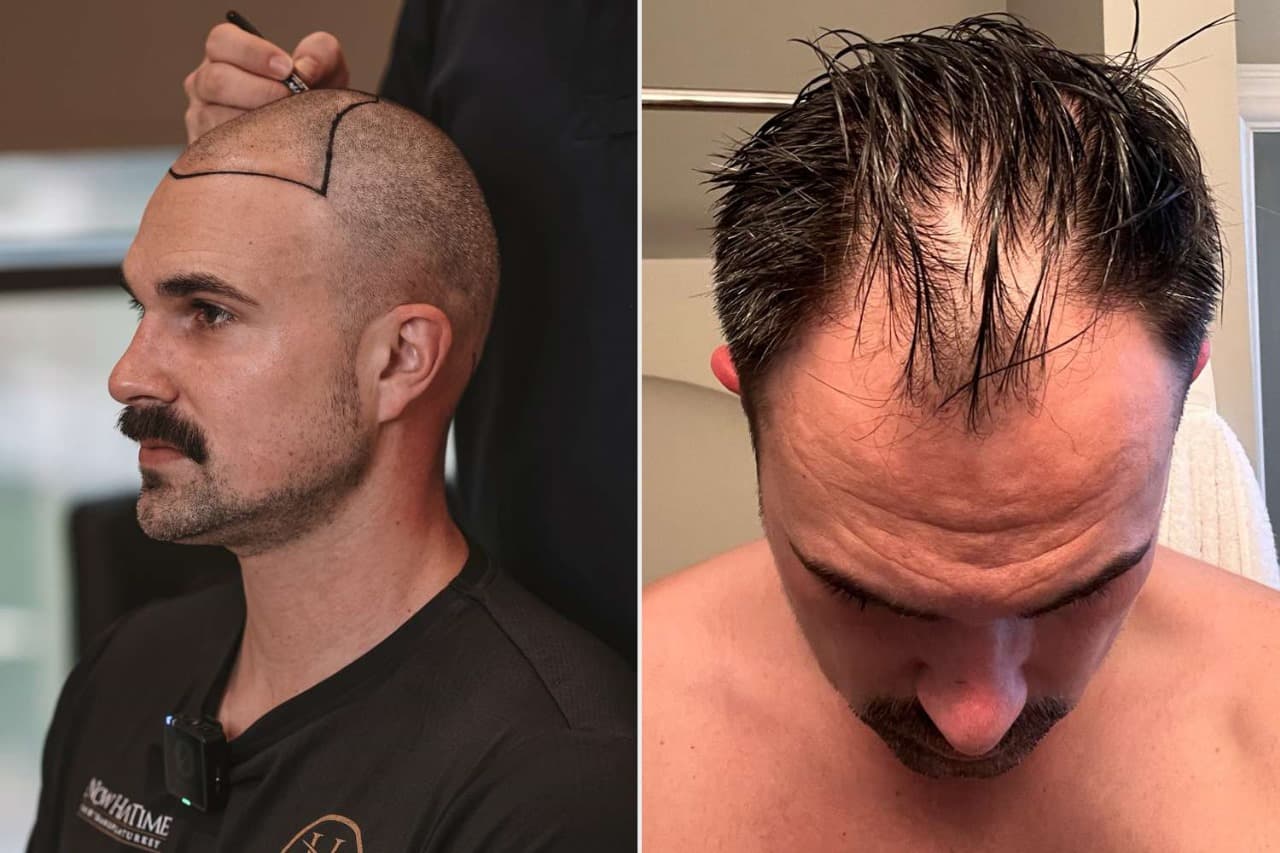 Hair Transplant London Experts: Trusted Care, Proven Success