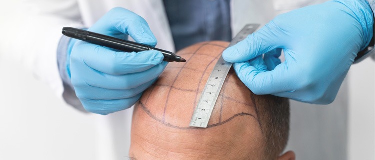 Hair Transplant Istanbul: Discover the Science Behind Success